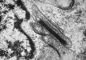 M,12y. | germinoma - intramitochondrial lamellar formation M,12y. | germinoma - intramitochondrial lamellar formation